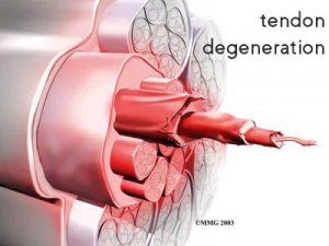 tendon degeneration