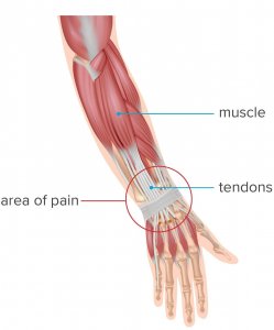 Guitar Tendonitis A Winning Strategy Guitarstrength